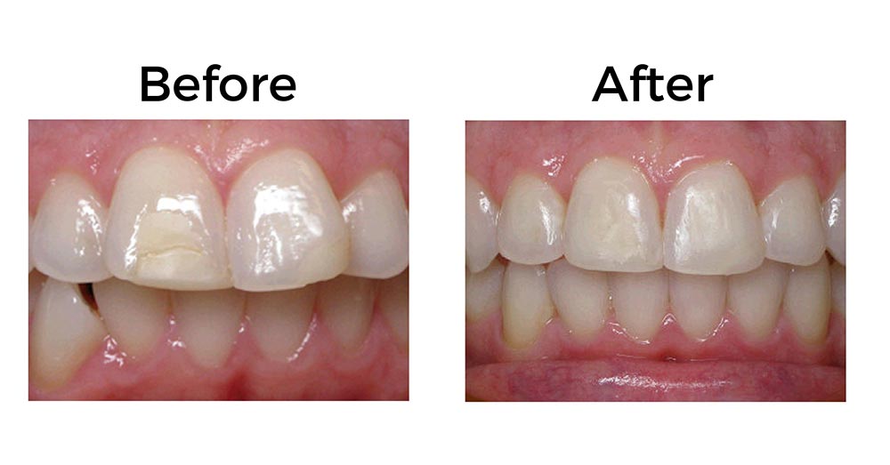 Clear Aligners And Invisalign With Altoona Smiles