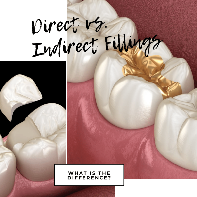 Direct vs. Indirect Fillings