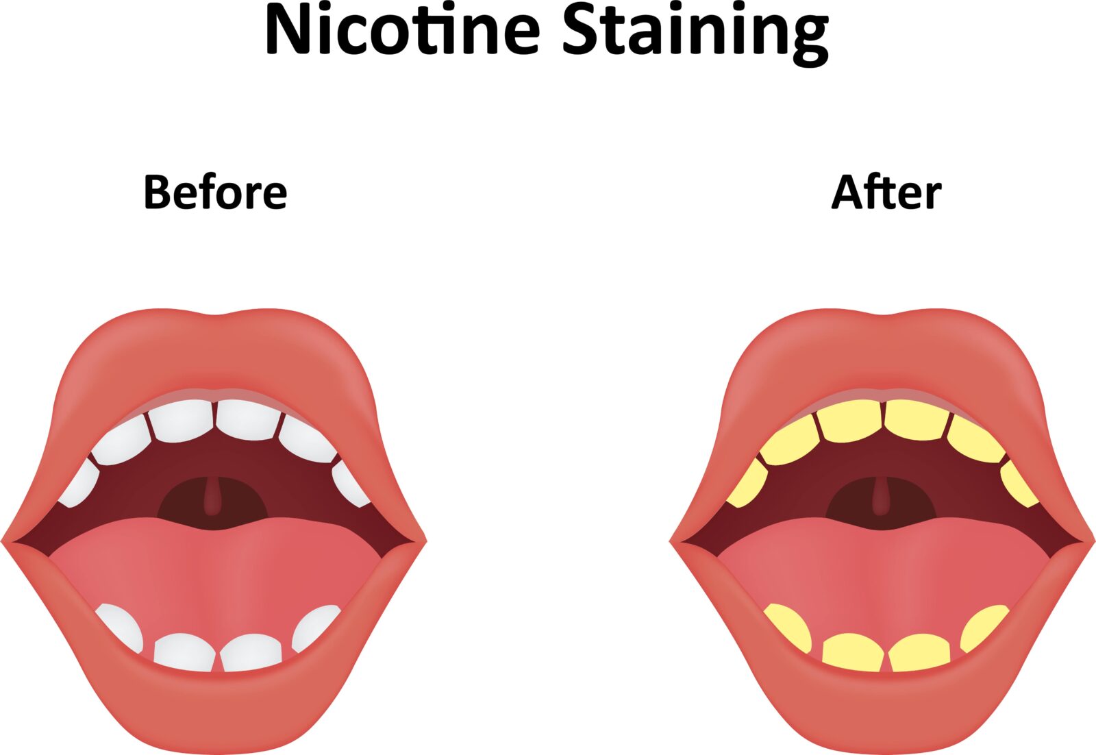 before and after nicotine staining on teeth